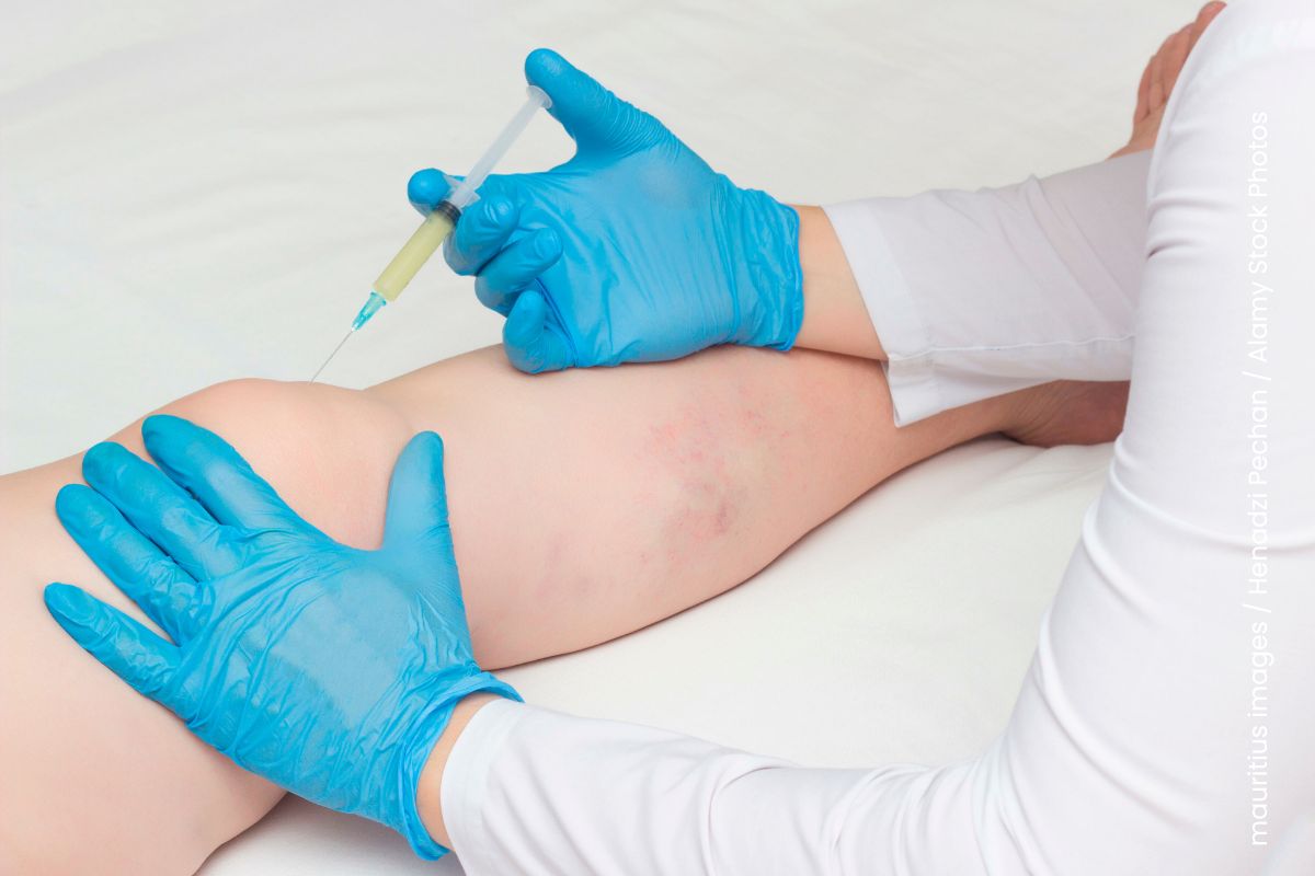 
Arzt injiziert Plasma in das Kniegelenk einer liegenden Patientin.
